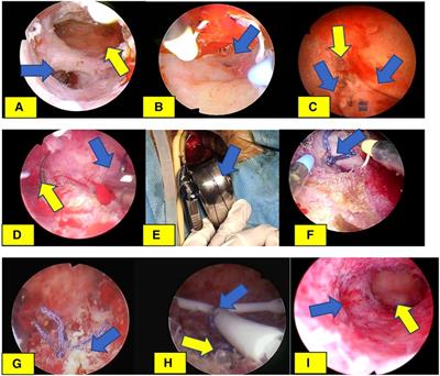 Case report: The intrauterine suture surgery—an original method in the treatment of old uterine false passage